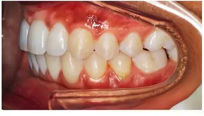 Sourire après un traitement Invisalign présenté par le cabinet