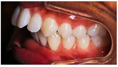 Sourire avant un traitement Invisalign présenté par le cabinet